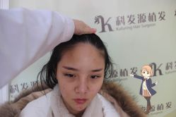 点击看大图 -大麦微针植发丨全国连锁