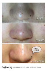 脸部抗衰-光SPA科技美肤