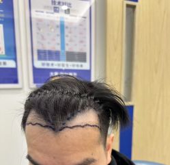 -大麦微针植发全国连锁