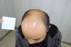 -大麦微针植发丨全国连锁