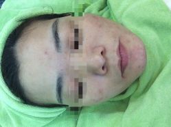 -苗医生草本科技祛痘