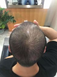 -大麦微针植发全国连锁