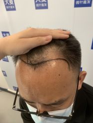 -大麦微针植发全国连锁