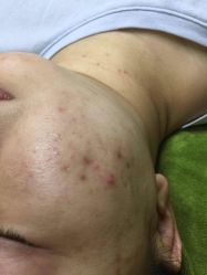 点击看大图 -苗方清颜痘肌研究所