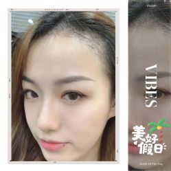-大麦微针植发全国连锁
