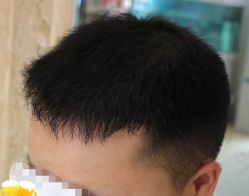 -大麦微针植发丨全国连锁