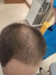 -碧莲盛·不剃发植发