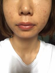 -爱莎扁平疣·汗管瘤·斑痣中心
