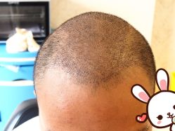 点击看大图 -大麦微针植发丨全国连锁