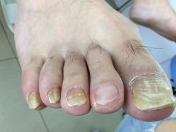 -德哥灰指甲脚气甲沟炎跖疣护理