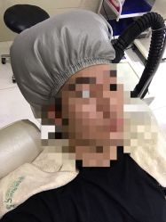 -大麦微针植发全国连锁