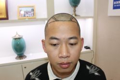 -大麦微针植发丨全国连锁