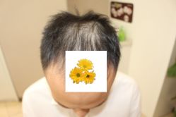 -大麦微针植发丨全国连锁