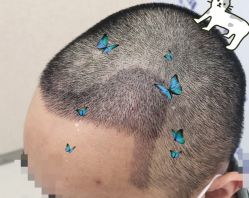 -大麦微针植发全国连锁