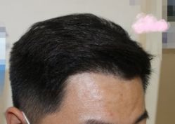 -大麦微针植发丨全国连锁