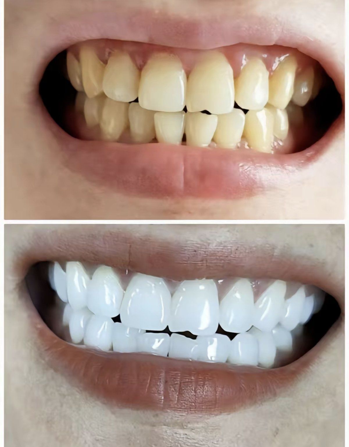 亮白牙齿自然闪耀