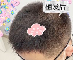 -大麦微针植发全国连锁