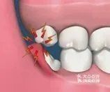 智齿不痛，需不需要拔?
