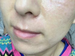 体验前-紫洁俪方（北京）医疗美容