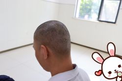 -大麦微针植发丨全国连锁