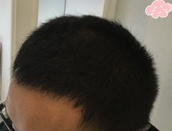 -大麦微针植发丨全国连锁