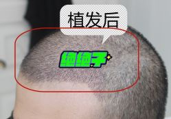 -大麦微针植发全国连锁