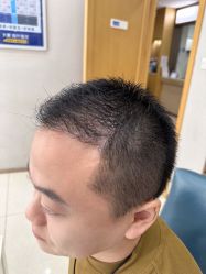 点击看大图 -大麦微针植发丨全国连锁