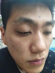 -北京美痣堂古方祛痣斑疣瘊
