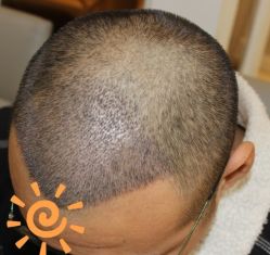 -大麦微针植发丨全国连锁