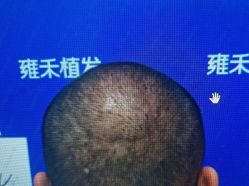 -雍禾植发全国连锁