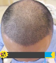 -大麦微针植发丨全国连锁