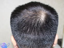 -大麦微针植发丨全国连锁