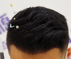 -大麦微针植发全国连锁