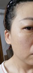 -爱莎扁平疣·汗管瘤·斑痣中心