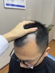 -大麦微针植发全国连锁