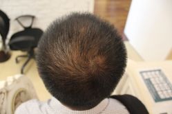 点击看大图 -大麦微针植发丨全国连锁