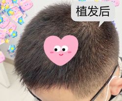 -大麦微针植发全国连锁