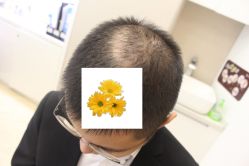 -大麦微针植发丨全国连锁