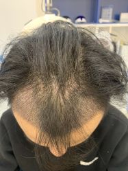 -大麦微针植发全国连锁