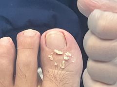 -Andrew指甲专科灰指甲·甲沟炎矫正·3D步态矫形鞋垫定制(浦三路店)
