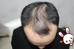 -大麦微针植发丨全国连锁