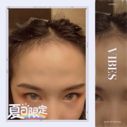 -大麦微针植发全国连锁