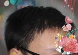 -大麦微针植发全国连锁
