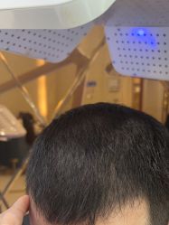 -碧莲盛·不剃发植发