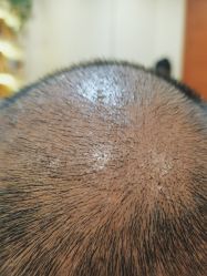 点击看大图 体验后-碧莲盛·不剃发植发