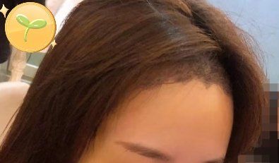 -大麦微针植发丨全国连锁