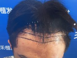 -雍禾植发全国连锁