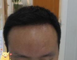 -大麦微针植发丨全国连锁