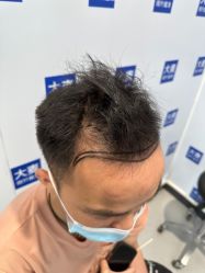 体验前-大麦微针植发全国连锁