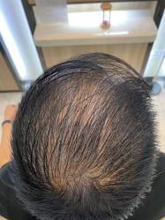 点击看大图 体验前-大麦微针植发丨全国连锁